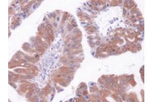 IHC-P analysis of Human Liver Cancer Tissue, with DAB staining. (GOT1 Antikörper  (AA 1-413))