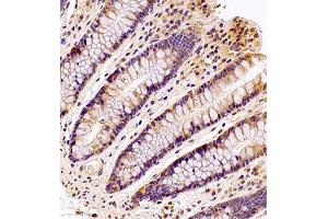 Immunohistochemistry analysis of paraffin embedded human colon using MTHFD1 (ABIN7074609) at dilution of 1: 700 (MTHFD1 Antikörper)