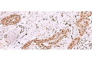 Immunohistochemistry of paraffin-embedded Human esophagus cancer tissue using ISL2 Polyclonal Antibody at dilution of 1:40(x200) (ISL2 Antikörper)
