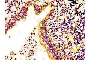 IHC image of ABIN7168192 diluted at 1:400 and staining in paraffin-embedded human lung cancer performed on a Leica BondTM system. (RPS6KA6 Antikörper  (AA 340-467))
