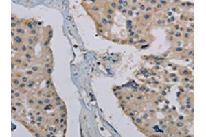 The image on the left is immunohistochemistry of paraffin-embedded Human prostate cancer tissue using ABIN7191867(PHKG1 Antibody) at dilution 1/20, on the right is treated with synthetic peptide. (PHKG1 Antikörper)