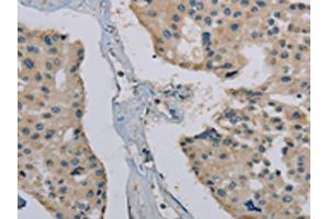 The image on the left is immunohistochemistry of paraffin-embedded Human prostate cancer tissue using ABIN7191867(PHKG1 Antibody) at dilution 1/20, on the right is treated with synthetic peptide.