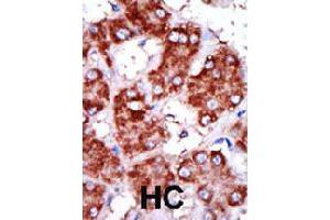 Formalin-fixed and paraffin-embedded human hepatocellular carcinoma tissue reacted with CPT1B polyclonal antibody  , which was peroxidase-conjugated to the secondary antibody, followed by DAB staining . (CPT1B Antikörper  (C-Term))