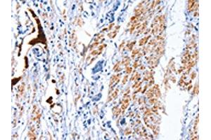 The image on the left is immunohistochemistry of paraffin-embedded Human prostate cancer tissue using ABIN7128792(CATSPER1 Antibody) at dilution 1/40, on the right is treated with fusion protein. (CATSPER1 Antikörper)