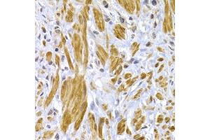 Immunohistochemistry of paraffin-embedded human gastric cancer using DSP antibody (ABIN6291454) at dilution of 1:100 (40x lens).