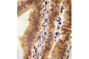 Immunohistochemistry analysis in formalin fixed and paraffin embedded human uterus tissue reacted with KIAA1609 Antibody (C-term) followed which was peroxidase conjugated to the secondary antibody and followed by AB staining.