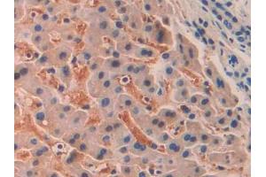 IHC-P analysis of Human Liver cancer Tissue, with DAB staining. (SIGLEC12 Antikörper  (AA 22-218))
