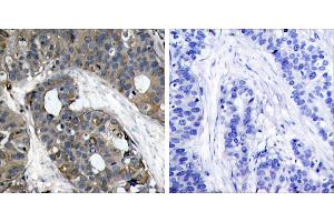 Peptide - +Immunohistochemical analysis of paraffin-embedded human breast carcinoma tissue using HSP27 (Ab-82) (Ab-232) antibody (#B7112). (HSP27 Antikörper  (pSer82))