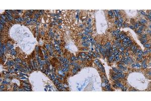 Immunohistochemistry of paraffin-embedded Human colon cancer using JAM-A Polyclonal Antibody at dilution of 1:40 (F11R Antikörper)