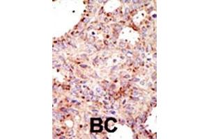 Formalin-fixed and paraffin-embedded human cancer tissue reacted with the primary antibody, which was peroxidase-conjugated to the secondary antibody, followed by AEC staining. (ARFGAP1 Antikörper  (C-Term))