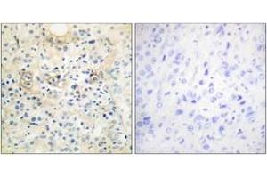 Immunohistochemistry analysis of paraffin-embedded human prostate carcinoma tissue, using TM16G Antibody. (Anoctamin 7 Antikörper  (AA 881-930))