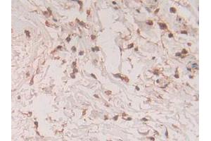 IHC-P analysis of Human Breast Cancer Tissue, with DAB staining. (S100A11 Antikörper  (AA 1-105))
