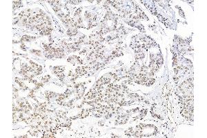 ABIN7094711 and ABIN7098762 at 1/100 staining Human breast cancer by IHC-P. (Histone H1.5 Antikörper  (N-Term))