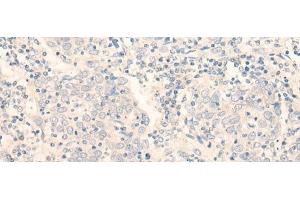 Immunohistochemistry of paraffin-embedded Human cervical cancer tissue using ADGRE3 Polyclonal Antibody at dilution of 1:35(x200) (EMR3 Antikörper)