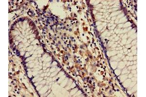 Immunohistochemistry of paraffin-embedded human colon cancer using ABIN7145576 at dilution of 1:100 (ATIC Antikörper  (AA 301-592))