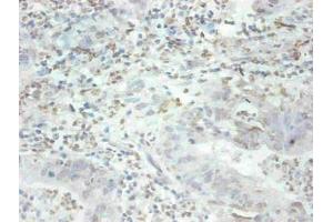 Immunohistochemical of paraffin-embedded human breast cancer tissue using ABIN7159679 at dilution of 1:200 (MFGE8 Antikörper)