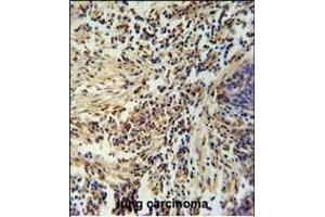ZN Antibody (Center) (ABIN654974 and ABIN2844614) immunohistochemistry analysis in formalin fixed and paraffin embedded human lung carcinoma followed by peroxidase conjugation of the secondary antibody and DAB staining. (ZNF720 Antikörper  (AA 34-62))