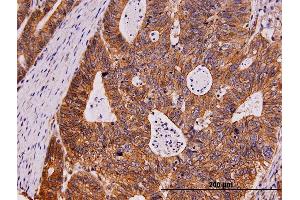 Immunoperoxidase of monoclonal antibody to KIT on formalin-fixed paraffin-embedded human stomach carcinoma.