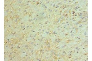Immunohistochemistry of paraffin-embedded human glioma using ABIN7145171 at dilution of 1:100 (BCL11A Antikörper  (AA 1-230))