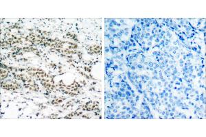 P-Peptide - +Immunohistochemical analysis of paraffin- embedded human breast carcinoma tissue using AFX (phospho-Ser197) antibody. (FOXO4 Antikörper  (pSer197))