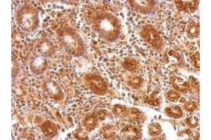 IHC-P Image ATP5A1 antibody [C2C3], C-term detects ATP5A1 protein at cytosol on human colon carcinoma by immunohistochemical analysis.