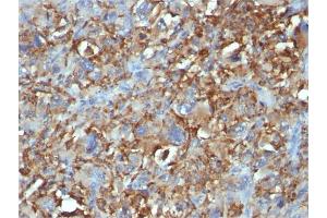 Formalin-fixed, paraffin-embedded human Histiocytoma stained with CD68 Mouse Monoclonal Antibody (C68/684). (CD68 Antikörper)