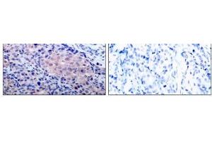 Immunohistochemical analysis of paraffin-embedded human breast carcinoma tissue using IκB-α (Ab- 32/36) antibody (E021122). (NFKBIA Antikörper)