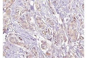 ABIN6274885 at 1/100 staining Human breast cancer tissue by IHC-P. (ABCD4 Antikörper  (Internal Region))