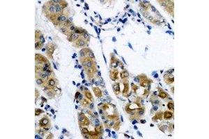 Immunohistochemical analysis of SerRS staining in human gastric cancer formalin fixed paraffin embedded tissue section. (Seryl-tRNA Synthetase (SARS) Antikörper)