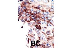 Formalin-fixed and paraffin-embedded human cancer tissue reacted with the primary antibody, which was peroxidase-conjugated to the secondary antibody, followed by DAB staining. (AXL Antikörper  (C-Term))