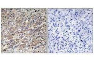 Immunohistochemistry analysis of paraffin-embedded human liver carcinoma tissue using COX17 antibody. (COX17 Antikörper  (N-Term))