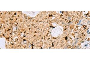 Immunohistochemistry of paraffin-embedded Human ovarian cancer tissue using MAF Polyclonal Antibody at dilution of 1:25(x200) (MAF Antikörper)