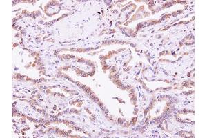 IHC-P Image CIB1 antibody detects CIB1 protein at cytoplasm on human lung carcinoma by immunohistochemical analysis. (CIB1 Antikörper)