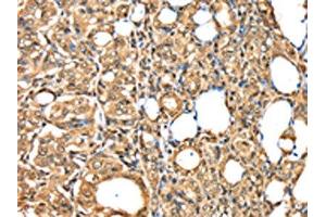 The image on the left is immunohistochemistry of paraffin-embedded Human thyroid cancer tissue using ABIN7192036(PSMB8 Antibody) at dilution 1/30, on the right is treated with synthetic peptide. (PSMB8 Antikörper)