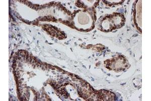Immunohistochemical staining of paraffin-embedded Human breast tissue using anti-ATRIP mouse monoclonal antibody. (ATRIP Antikörper  (AA 42-309))