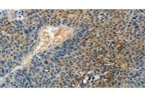 Immunohistochemistry of paraffin-embedded Human liver cancer tissue using DGK beta Polyclonal Antibody at dilution 1:60