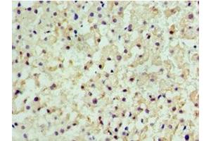 Immunohistochemistry of paraffin-embedded human liver cancer using ABIN7147368 at dilution of 1:100 (CENPQ Antikörper  (AA 131-268))