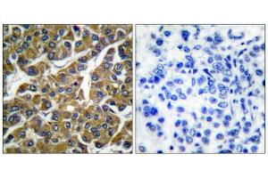 Immunohistochemical analysis of paraffin-embedded human breast carcinoma tissue, using MMP3 antibody (ABIN5976463). (MMP3 Antikörper  (C-Term))