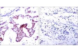 Immunohistochemistry analysis of paraffin-embedded human breast carcinoma, using NF-kappaB p65 (Phospho-Ser276) Antibody.