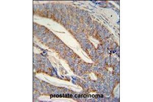DACT1 antibody immunohistochemistry analysis in formalin fixed and paraffin embedded human prostate carcinoma followed by peroxidase conjugation of the secondary antibody and DAB staining. (DACT1 Antikörper  (N-Term))