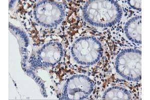 Immunohistochemical staining of paraffin-embedded Carcinoma of Human lung tissue using anti-ARHGAP25 mouse monoclonal antibody. (ARHGAP25 Antikörper)