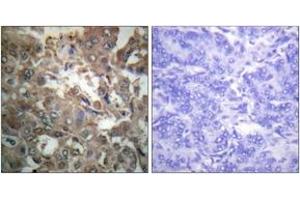 Immunohistochemistry analysis of paraffin-embedded human breast carcinoma tissue, using XPA Antibody. (PA (AA 211-260) Antikörper)