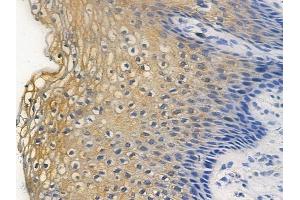 ABIN6255524 and ABIN6267296 at 1/100 staining human cervical carcinoma by IHC-P. (HSP27 Antikörper  (pSer82))