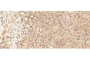 Immunohistochemistry of paraffin-embedded Human ovarian cancer tissue using FBXL4 Polyclonal Antibody at dilution of 1:25(x200) (FBXL4 Antikörper)