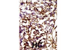 Formalin-fixed and paraffin-embedded human hepatocellular carcinoma tissue reacted with CDK4 polyclonal antibody  , which was peroxidase-conjugated to the secondary antibody, followed by AEC staining. (CDK4 Antikörper  (AA 273-305))
