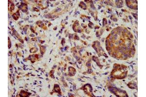 IHC image of ABIN7156494 diluted at 1:400 and staining in paraffin-embedded human pancreatic cancer performed on a Leica BondTM system. (ITGB6 Antikörper  (AA 451-586))