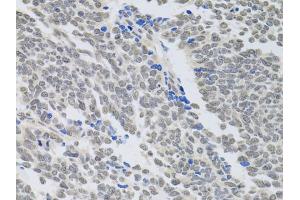 Immunohistochemistry of paraffin-embedded human lung cancer using PAX3 antibody (ABIN6290725) at dilution of 1:100 (40x lens). (Paired Box 3 Antikörper)