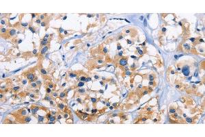 Immunohistochemistry of paraffin-embedded Human thyroid cancer tissue using CAPZA3 Polyclonal Antibody at dilution 1:70