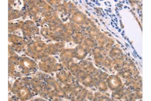 The image on the left is immunohistochemistry of paraffin-embedded Human thyroid cancer tissue using ABIN7128689(BTG3 Antibody) at dilution 1/15, on the right is treated with fusion protein.
