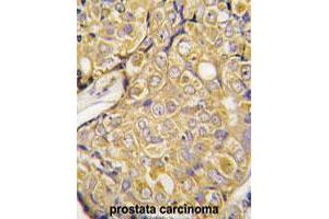 Formalin-fixed and paraffin-embedded human prostate carcinoma tissue reacted with TRPM8 polyclonal antibody  , which was peroxidase-conjugated to the secondary antibody, followed by DAB staining. (TRPM8 Antikörper  (Internal Region))